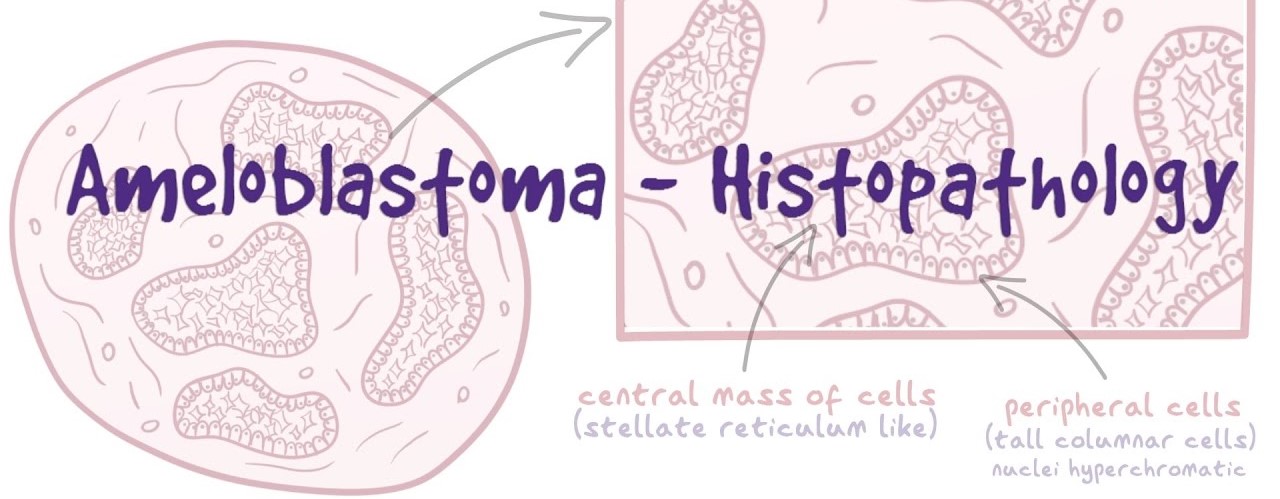 Ringkas dan Lengkap tentang Ameloblastoma