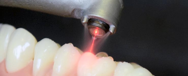Penggunaan Laser dalam Kedokteran Gigi – Berbagai Tipe Dental Laser