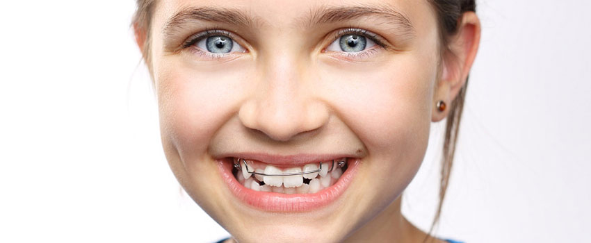 Kiat Merawat Kesehatan Gigi Anak dokter gigi depok behel gigi atas