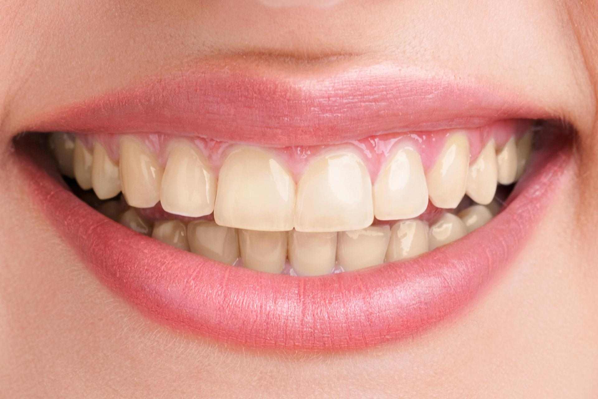 Image result for dientes limpios y sucios