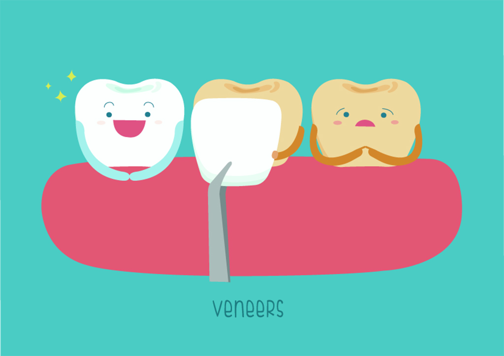 Kelebihan dan Kekurangan Veneer Gigi dokter gigi bandung