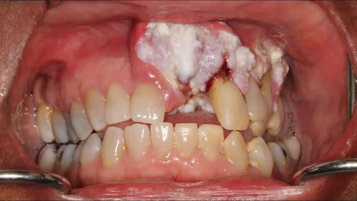 Jika Lihat Tanda Ini di Mulut Anda, Ayo Segera Periksa ke Klinik Gigi Terdekat!