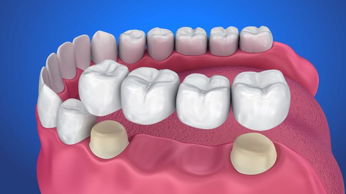 biaya implant gigi jakarta utara